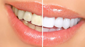 همه آنچه که برای سفید کردن دندانهایتان نیاز دارید محصولات خانگی ساده ای هستند که بسادگی یافت می شوند-خوردن کرفس و سیب-مسواک-توت فرنگی بخورید